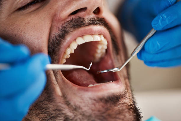 Best Emergency Wisdom Teeth Removal in Golden Gate, FL